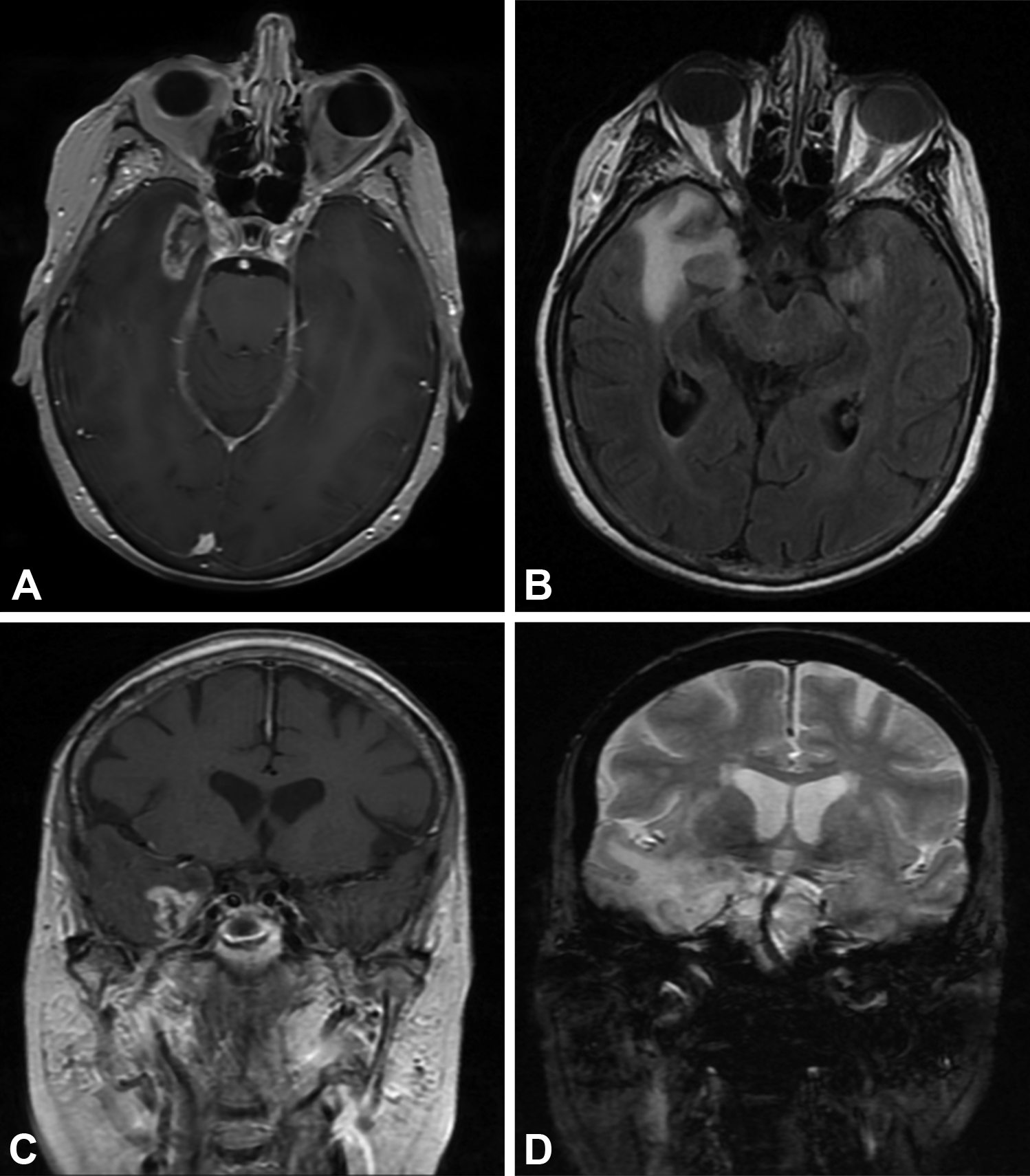 Radiation Radiation Necrosis